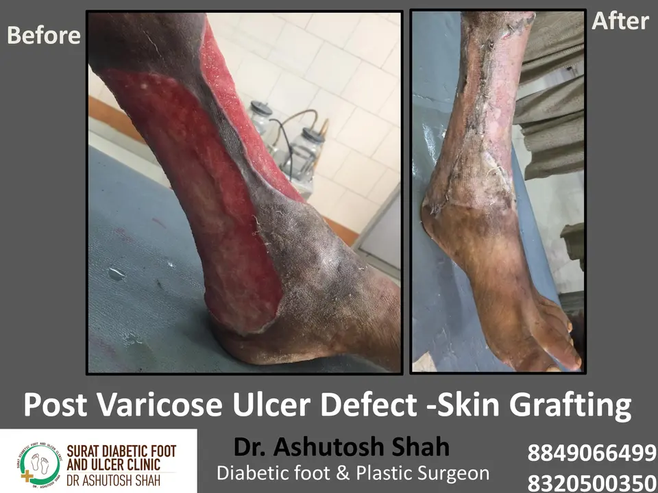 Varicose veins and Ulcers.pptx-5.webp